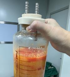 威海水动力吸脂手术要做多久？